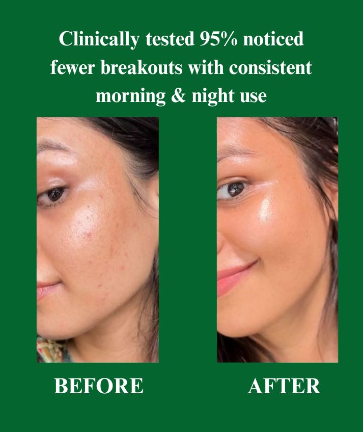 Anti Acne facewash