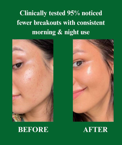 Anti Acne facewash