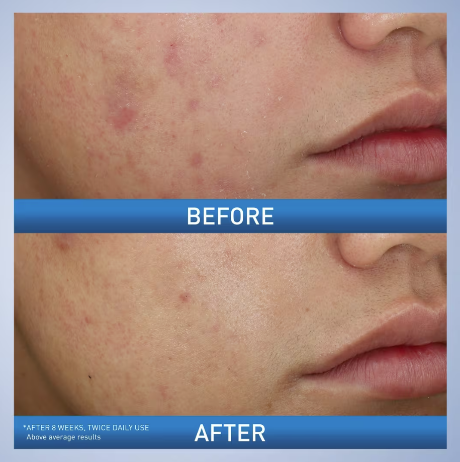 CeraVe Acne Foaming Cream Wash