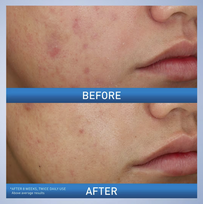 CeraVe Acne Foaming Cream Wash