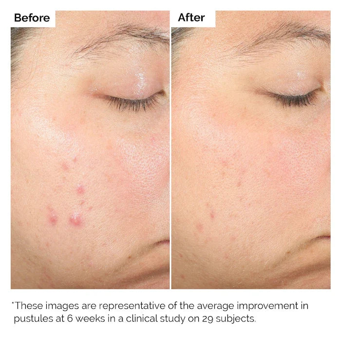 The Ordinary Salicylic Acid 2% Blemish Solution